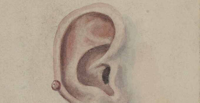 A Drawing Of A Man'S Ear - Naevus On The Right Ear Of A Male Patient